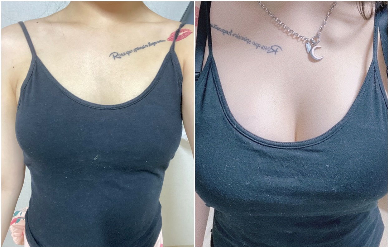 Real Review Breast Augmentation: Hasil Natural Seperti Payudara Asli!
