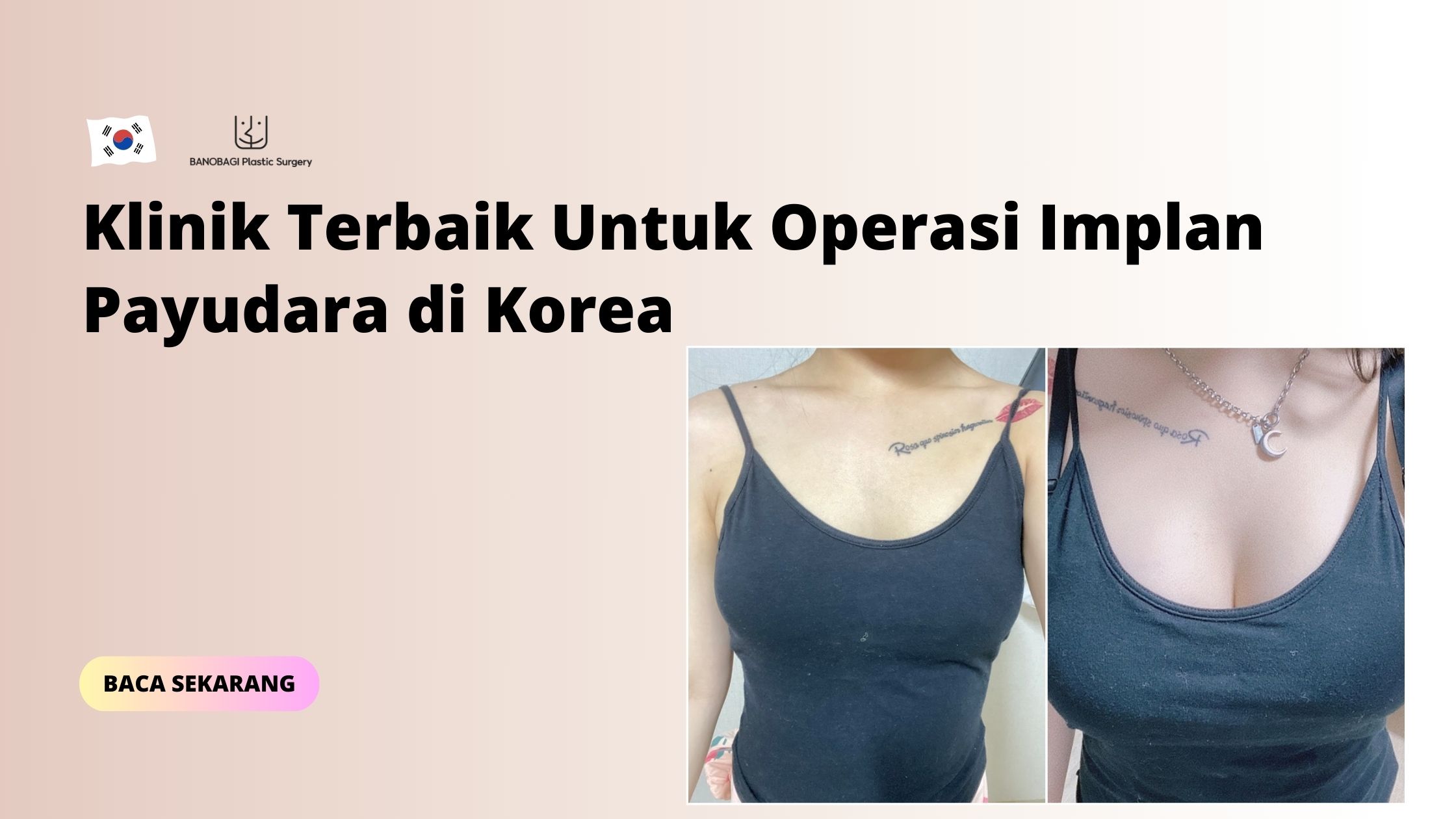 operasi implan payudara di Korea