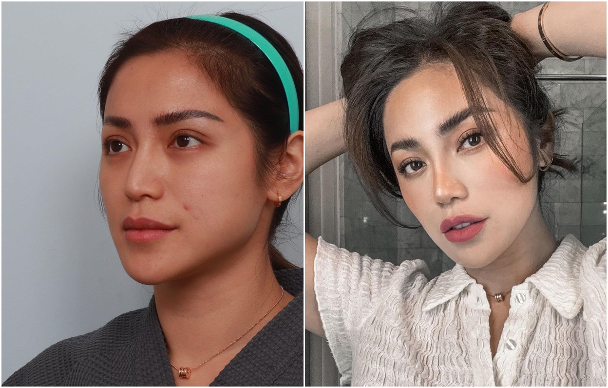 Penampilan Jessica Iskandar Setelah Operasi Hidung di BANOBAGI Korea!