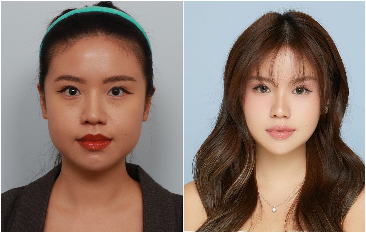 Cerita Influencer Indonesia, Titan Tyra Setelah Operasi Rahang dan Dagu!