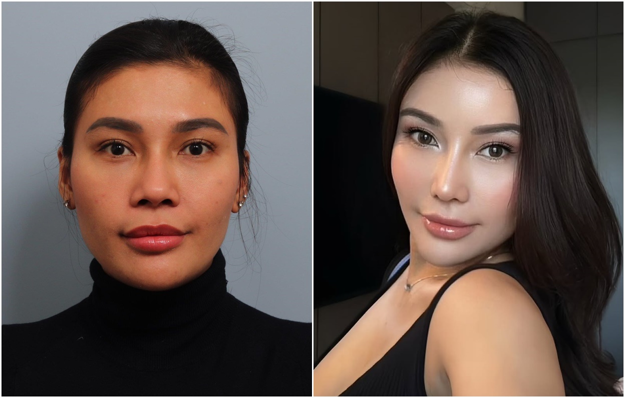 Rhinoplasty dan Fat Graft Untuk Dapatkan Wajah Baby Face!