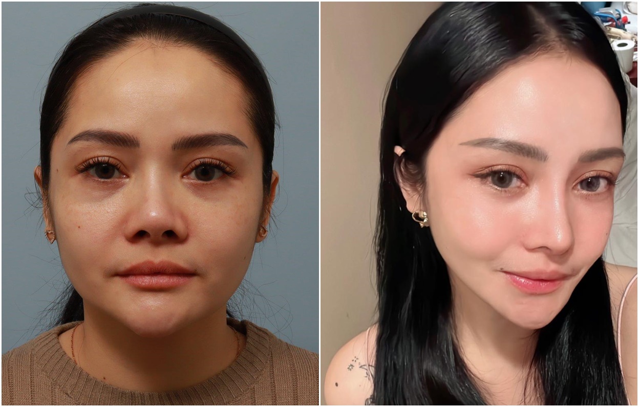 Mawar AFI: Operasi Plastik Bukan Cuma Untuk Cantik, Tapi Untuk Kebutuhan