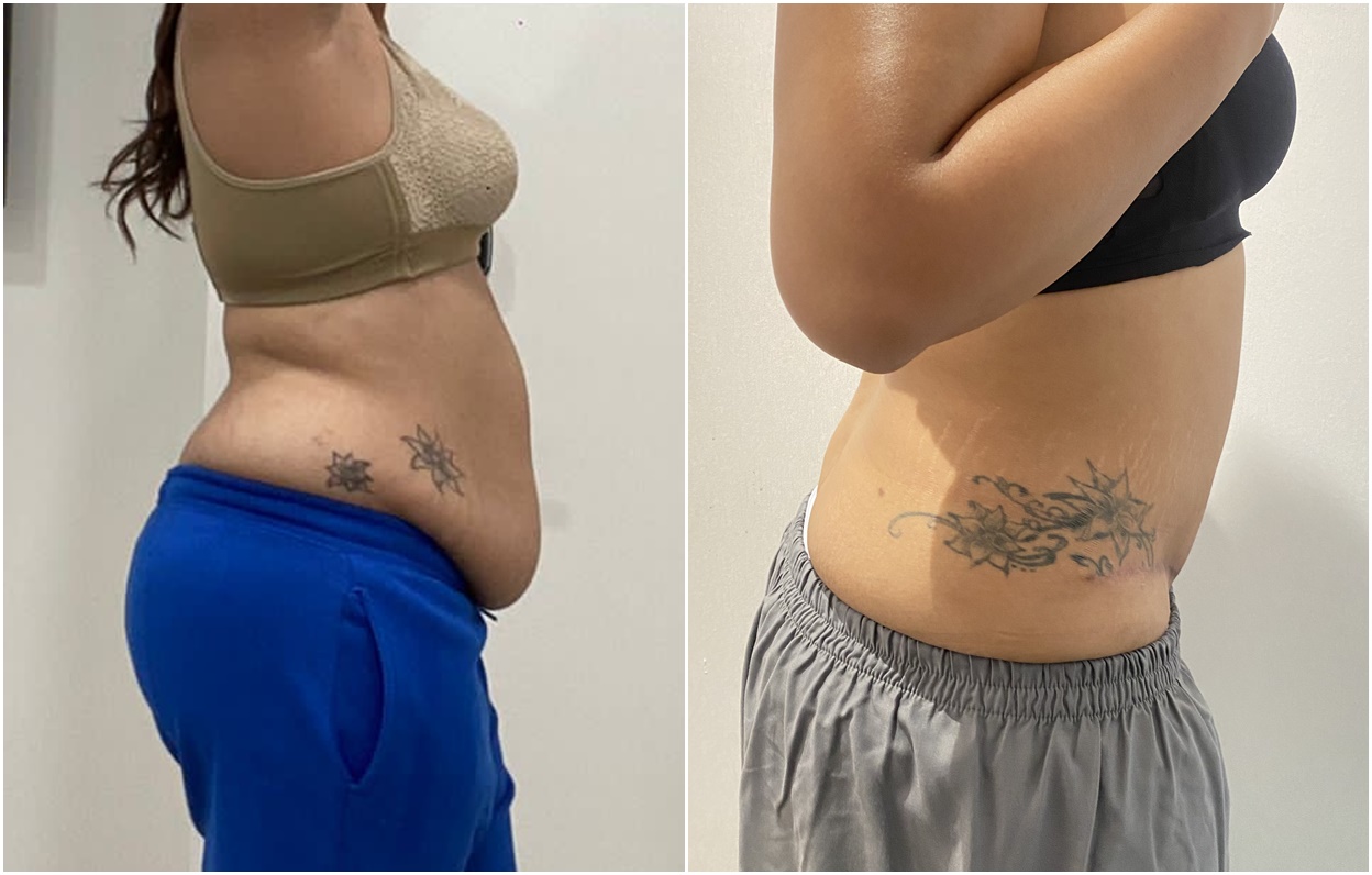 Mommy Make Over: Tummy Tuck, Body Liposuction, Ptosis Correction & Fat Graft