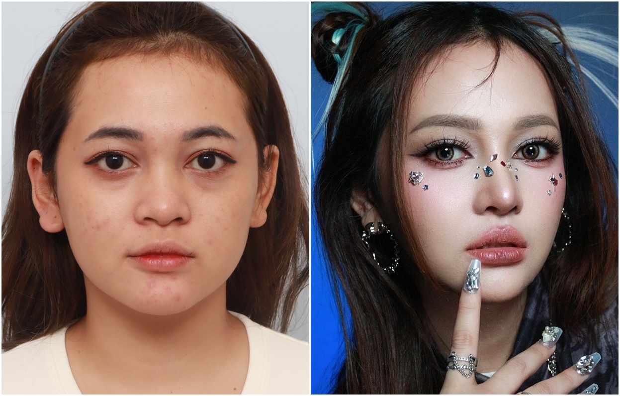 Pengalaman Operasi Hidung, Forehead Lift, dan Kontur Wajah!