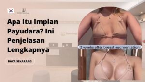 Apa Itu Implan Payudara? Ini Penjelasan Lengkapnya
