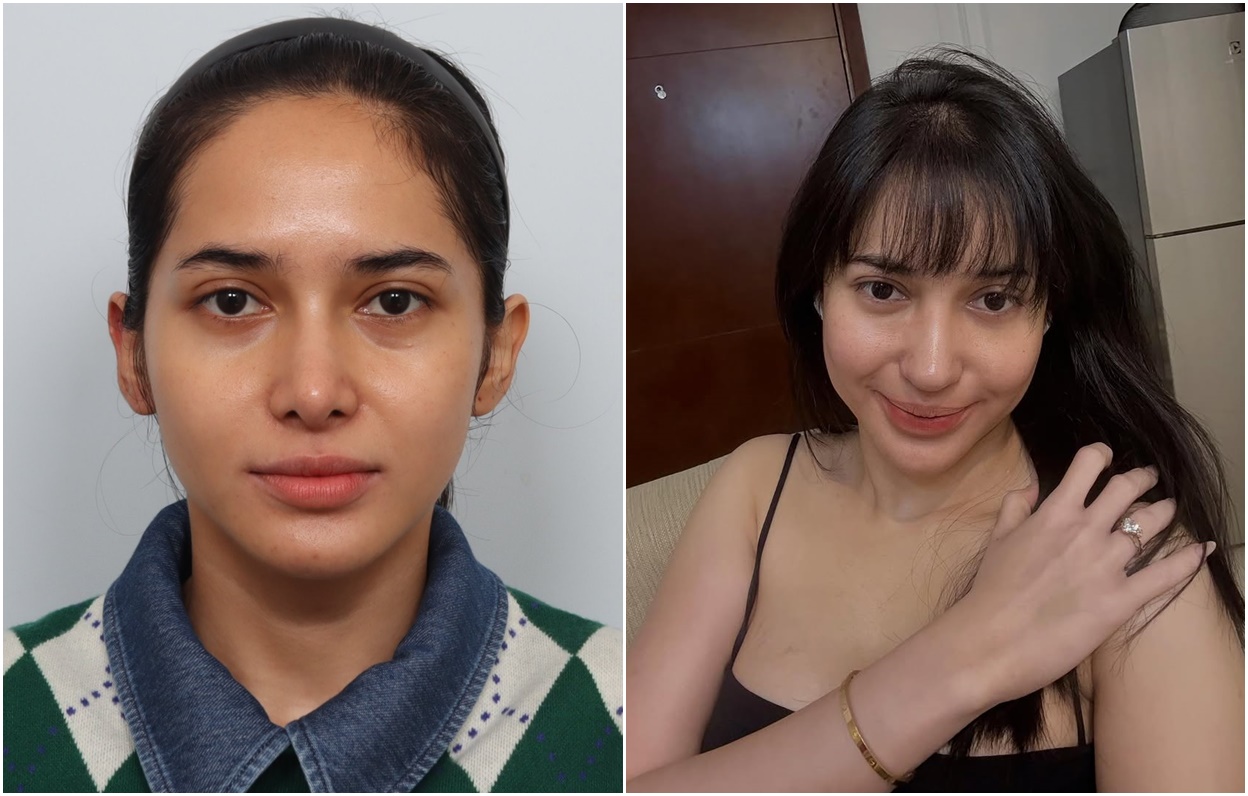 Cerita Dilan Janiyar, Influencer Terkenal Indonesia Setelah Operasi Plastik di BANOBAGI