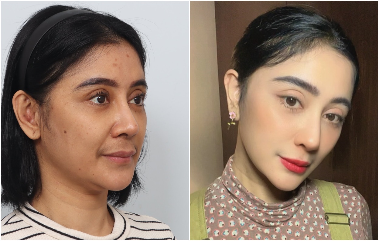 Perjalanan Uut Permatasari dari Sebelum Operasi sampai 10 Bulan Setelahnya