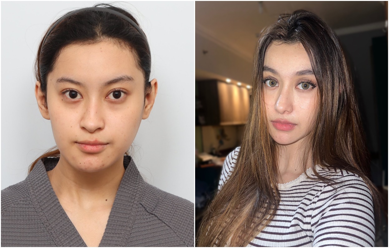Sering Dibully Wajah Asimetris, Influencer Indonesia Operasi Plastik di Korea