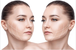 Operasi Tulang Pipi (Zygoma Reduction) di Korea