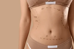 Abdominoplasti Korea: Panduan Lengkap Prosedur Pengencangan Perut