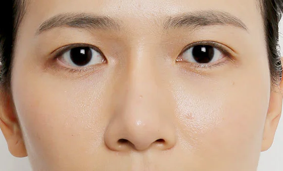 Revisi hidung sebelum