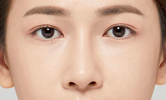 Revisi hidung sesudah