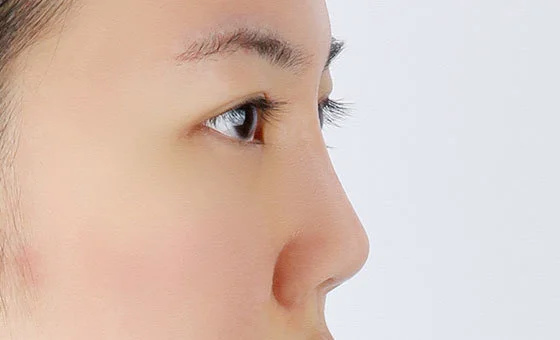 Revisi hidung sebelum