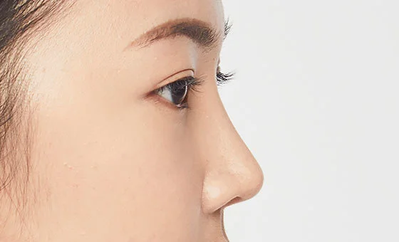 Revisi hidung sesudah
